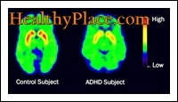 Termineid ADD ja ADHD on kasutatud vaheldumisi. Uuendatud termin vastavalt DSM IV-le on aga ADHD (tähelepanupuudulikkuse hüperaktiivsuse häire).